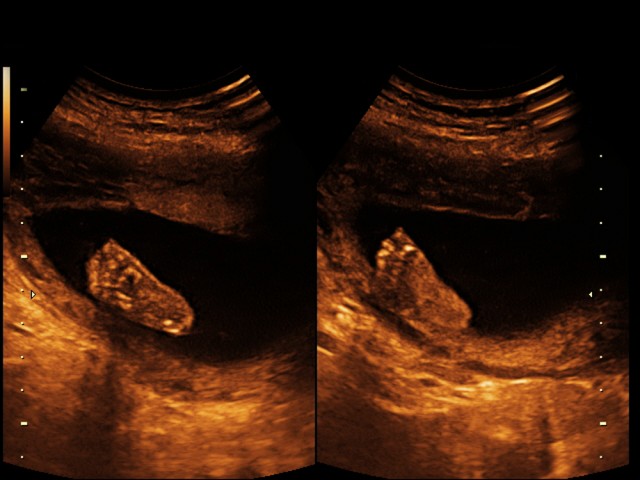 BE repudia objecção de consciência  dos médicos do SESARAM em relação ao aborto