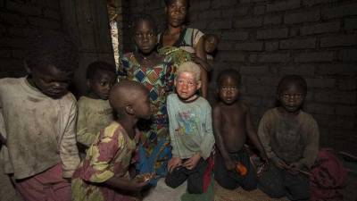 Amnistia Internacional apela aos países da África Austral para protegerem os albinos