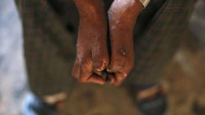 Brasil e Moçambique entre países com lepra em que ONU diz ser prioritário agir
