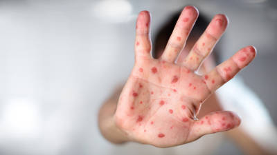 Brasil registou mais de mil casos de sarampo até Agosto
