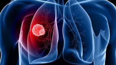 Cientistas estimam que 1,4 milhões de pessoas da UE vão morrer de cancro em 2019