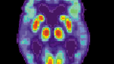 Cientistas investigam proteína que pode retardar ou impedir Alzheimer