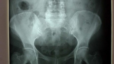 Descoberta técnica que permite detectar lesões renais de forma rápida e exacta