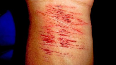 Psiquiatras alertam que sensacionalismo sobre Baleia Azul aumenta automutilações