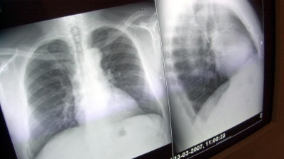 Tuberculose resistente aos medicamentos ameaça décadas de progressos